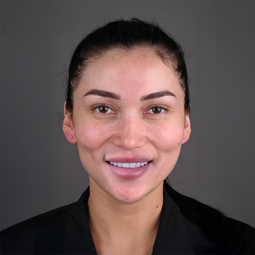 Dental Implant Patient Photo
